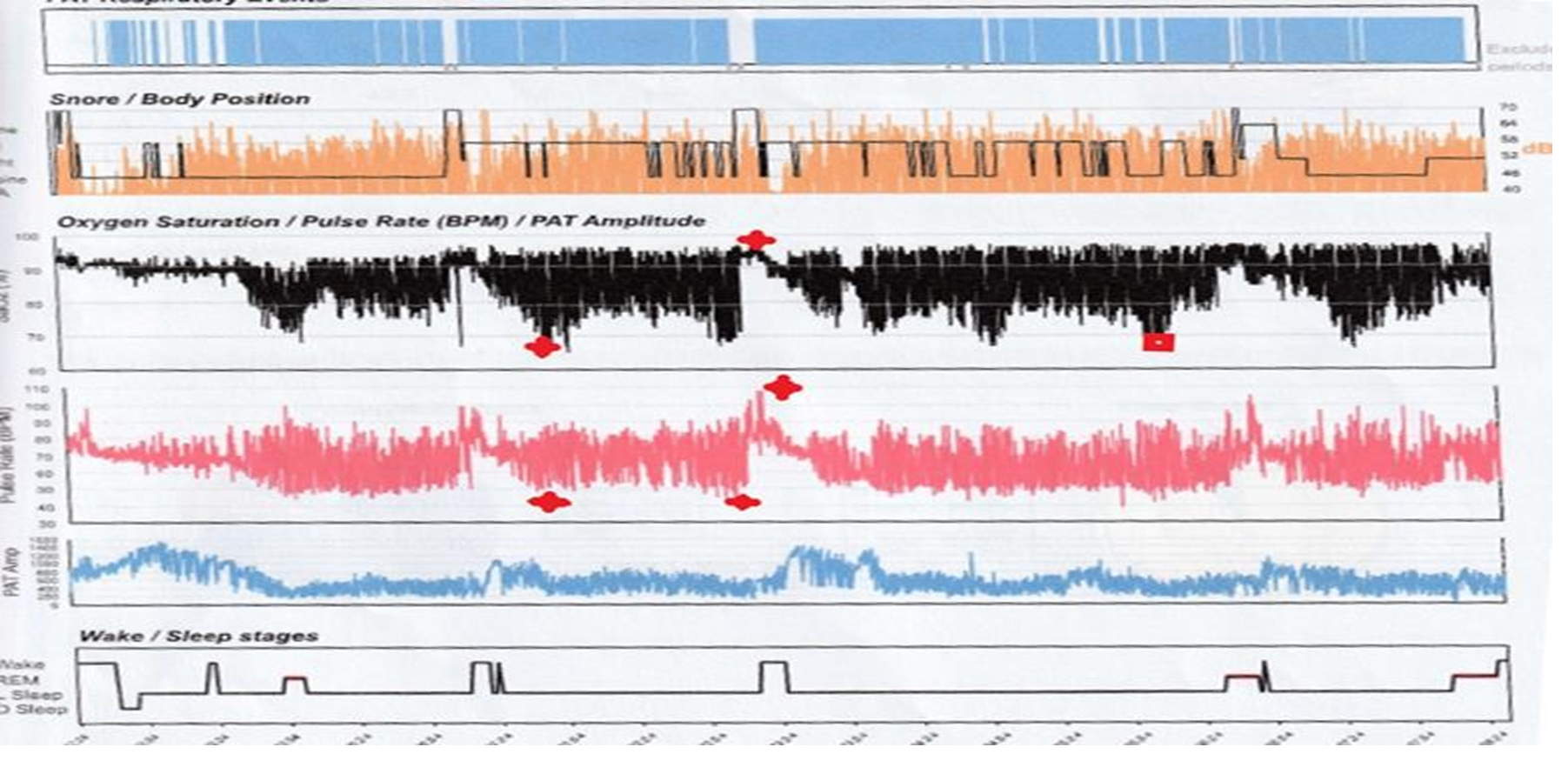 Polysomnographie - Graphique 1